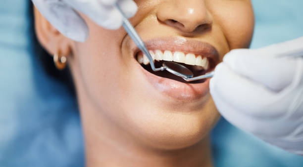 Best Emergency Wisdom Teeth Removal in Vineyard, CA